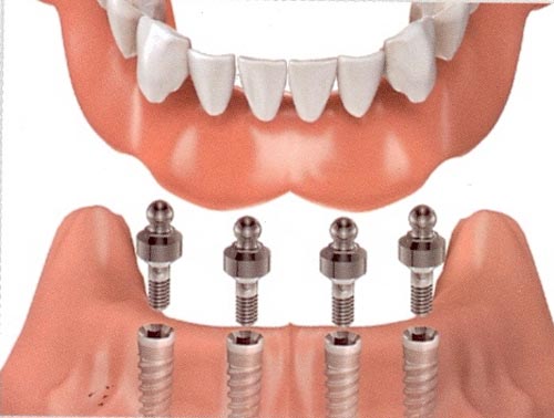 Cấy Implant có đau không và Nguy Hiểm Không?