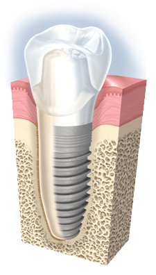 Cấy ghép Implant là gì