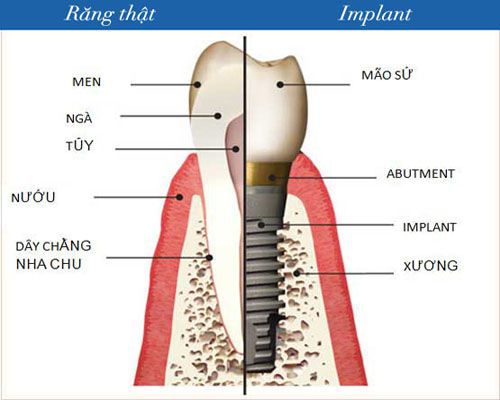 Trồng Răng Implant Giá bao nhiêu, cấu tạo trụ răng Implant