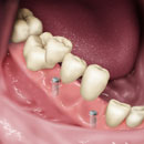 Cấy Implant là gì? Gắn mão sứ lên trụ Implant