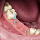 Cấy Implant là gì