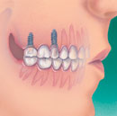 Cấy Implant là gì? Mặt cắt mô tả trụ Implant và mão bọc răng sứ bên trong