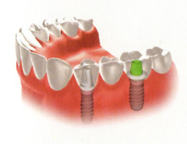Giải Pháp cấy Implant do mất nhiều răng
