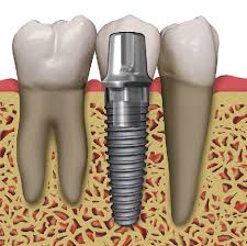 Dịch Vụ Cấy ghép Implant