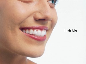 Niềng Răng Không Nhổ Răng là gì và Hiệu quả tốt không khi dùng Khay Nhựa Invisalign
