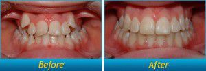Niềng Răng Không Nhổ Răng Dùng Khí Cụ Trước và Sau Niềng Răng