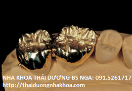 Phục Hình Trồng răng Giả Cố định dùng Mão Kim loại Vàng 24K