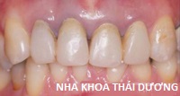 Phục hình răng giả cố định là gì - Trám răng thẩm mỹ composite