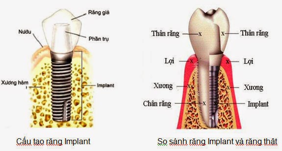 Cấu tạo Trụ Răng Implant và Răng thật