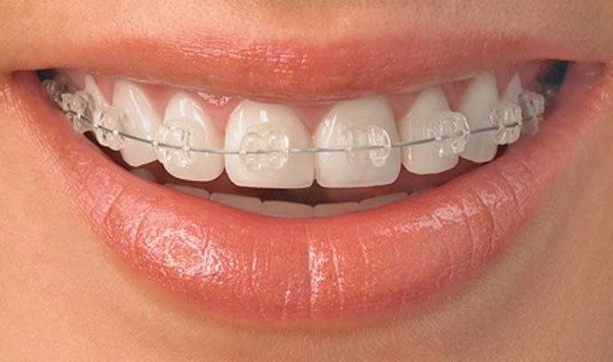 Răng Thưa phải làm sao và cách khắc phục hiệu quả nhất- Phương Pháp Niềng răng