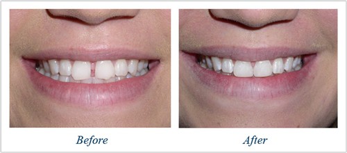 Răng Thưa phải làm sao và cách khắc phục hiệu quả tương đối bằng trám răng thẩm mỹ