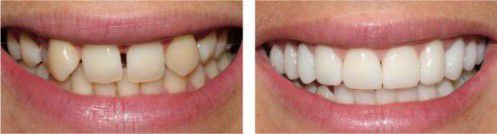 Răng Thưa phải làm sao và cách khắc phục hiệu quả nhất là gì?