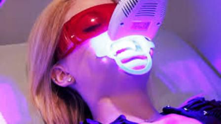 Tẩy Trắng răng bằng đèn Plasmatrong 1 giờ
