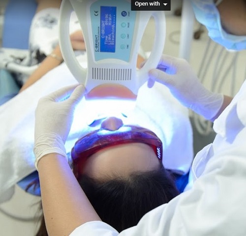 Răng Giả Implant Tẩy trắng được không