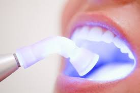 Tẩy trắng răng Laser