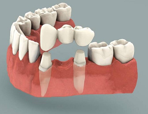 Trồng Răng Giả cố định vĩnh viễn bằng cách dùng Cầu Răng Sứ