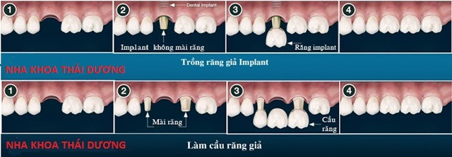 Trồng răng Giả Implant Cố định Vĩnh Viễn dùng Cầu Răng Sứ