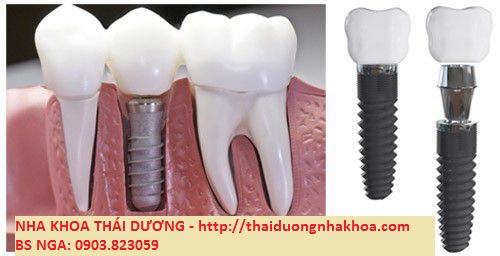 Trồng Răng Giả Implant là Gì? Cấy Ghép IMPLANT Là Gì?