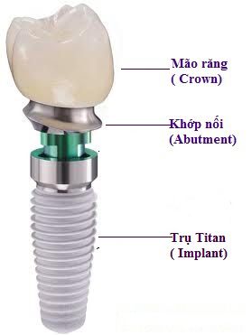 Trồng răng giả Implant- Cấu tạo Răng Implant