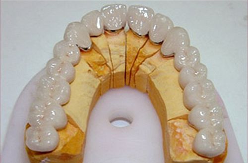 Trồng Răng Giả bằng giải pháp Răng sứ