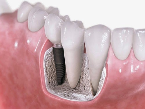 Trồng răng Implant và Bọc răng sứ