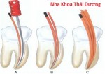 Hậu quả của Chữa Tủy Răng không Sạch và Nguy Hiểm thế nào