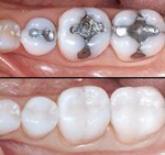 Làm răng sứ thẩm mỹ đau không và Bọc răng sứ có biến chứng gì không?