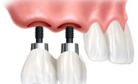 Mất Răng Trồng răng Implant để phục hồi sức nhai và thẩm mỹ