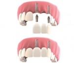 Mất răng và Giải pháp Cấy Ghép Implant, Trồng Răng Implant sẽ giúp tái tạo sức nhai và Thẩm Mỹ hiệu quả nhất cho tất cả các trường hợp mất răng