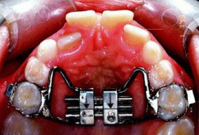 Niềng Răng không Nhổ răng là gì và Hiệu quả tốt không?