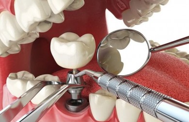 Răng Giả Implant Tẩy Trắng Được Không?