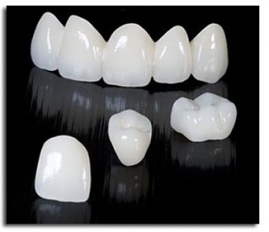 Răng sứ thẩm mỹ Cercon là gì, đẹp không, giá rẻ hay mắc, đẹp như răng thật không?