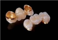 Răng Sứ Thẩm Mỹ