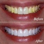 Tẩy Trắng Răng Tại nhà-7 cách làm trắng răng nhanh chóng