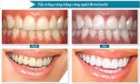 Tẩy Trắng Răng