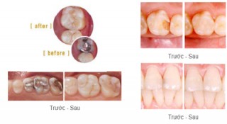 Khuyến Mãi 8.3 & 30.4 Trám răng Thẩm mỹ 5%-10% giá rẻ nhất, đẹp nhất HCM Dịp KHAI TRƯƠNG CN3 26 D5 BT Trước 5.5.2023