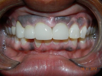 Implant-Re-Ben-sau