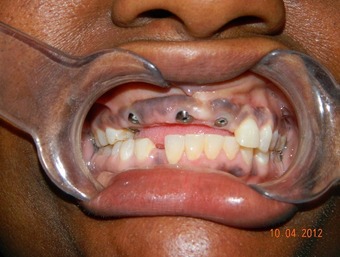 Implant-gia-re-sau