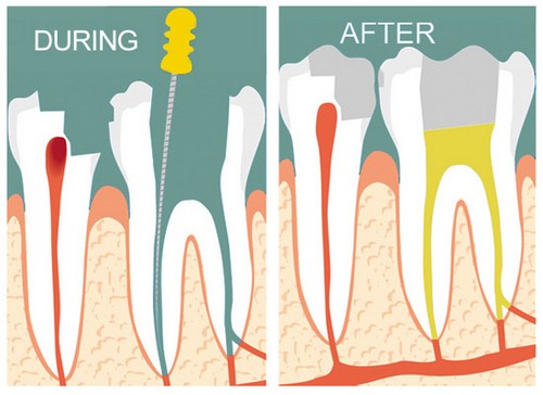 Lấy tủy răng đau không, nhức không, lấy tủy răng làm lâu không