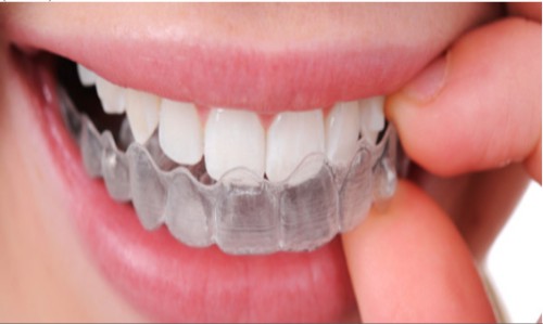 Niềng Răng Trong Suốt Clear Aligner và Invisalign là gì? Hiệu quả Niềng Răng Nhanh không?