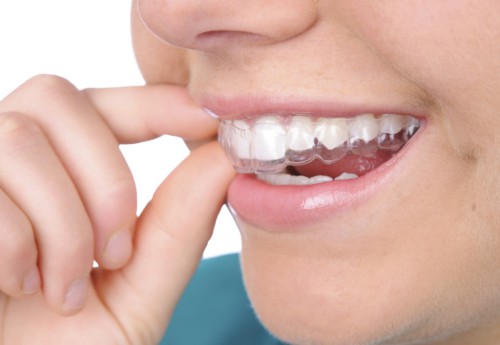 Niềng Răng Trong Suốt giá bao nhiêu TIỀN?