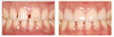 Bọc Răng sứ Như thế nào cho Răng bị mẻ