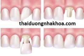 Quy trình Bọc Răng sứ Như thế nào?