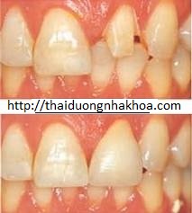 Quá Trình Bọc Răng sứ như thế nào cho Răng Cử bị Mẻ