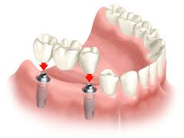 Bọc răng sứ tốt nhât TPHCM gắn lên trụ Implant
