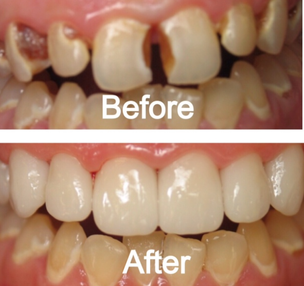 Bọc răng sứ ở đâu tốt nhât TPHCM Trước và Sau khi bọc răng Sứ