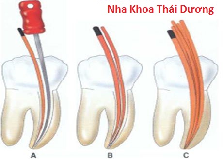 Quy Trình chữa Tủy răng thế nào?