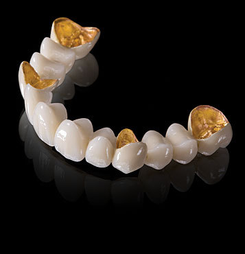 Giá răng sứ Titan