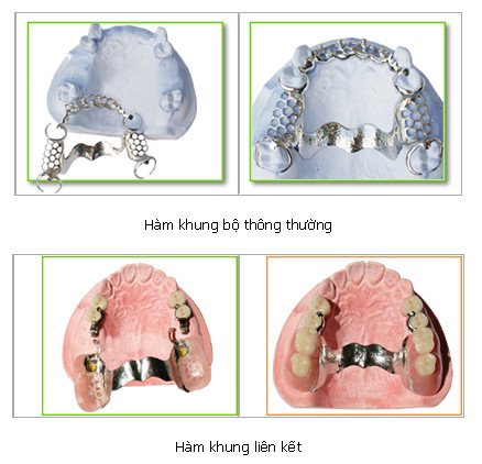 Hàm răng giả tháo lắp Hàm răng giả tháo lắp
