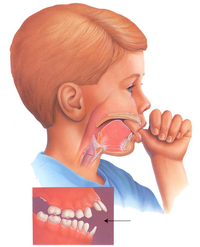 Bệnh Khớp Cắn Hở do trẻ mút tay